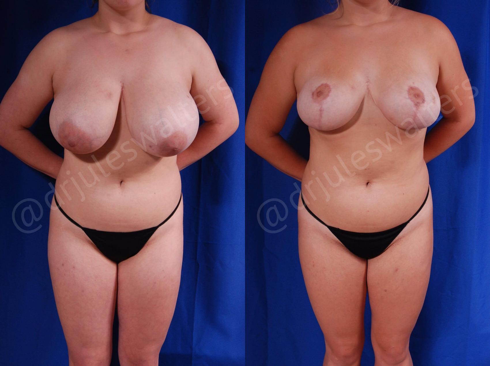 Before & After Breast Reduction Case 126 View #1 View in Metairie and New Orleans, LA