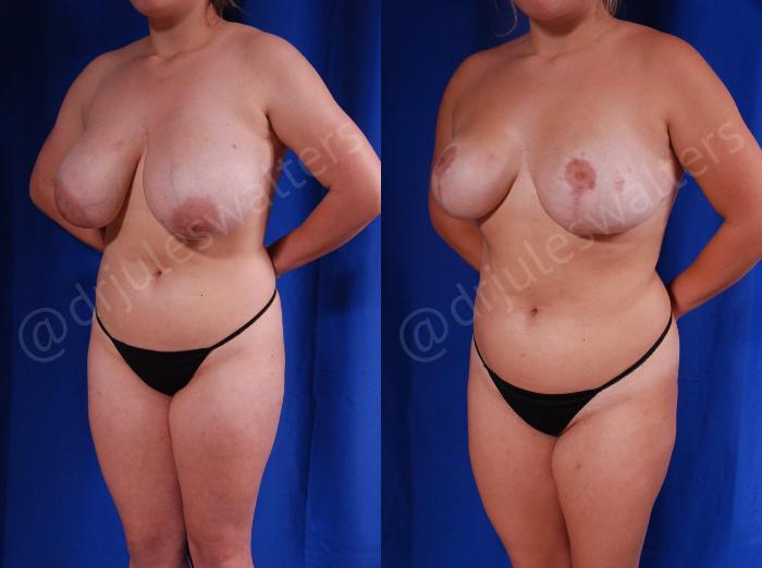 Before & After Breast Reduction Case 126 View #2 View in Metairie and New Orleans, LA