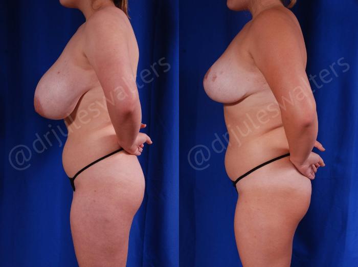 Before & After Breast Reduction Case 126 View #3 View in Metairie and New Orleans, LA