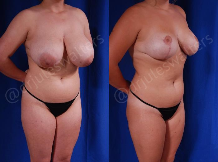 Before & After Breast Reduction Case 126 View #4 View in Metairie and New Orleans, LA