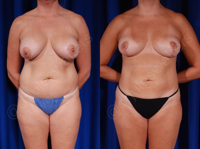 Before & After Breast Revision Case 127 View #1 View in Metairie and New Orleans, LA