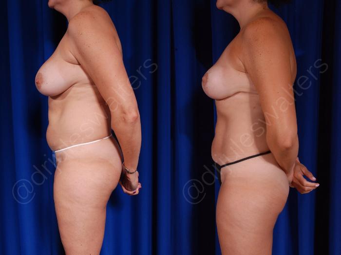 Before & After Breast Revision Case 127 View #2 View in Metairie and New Orleans, LA