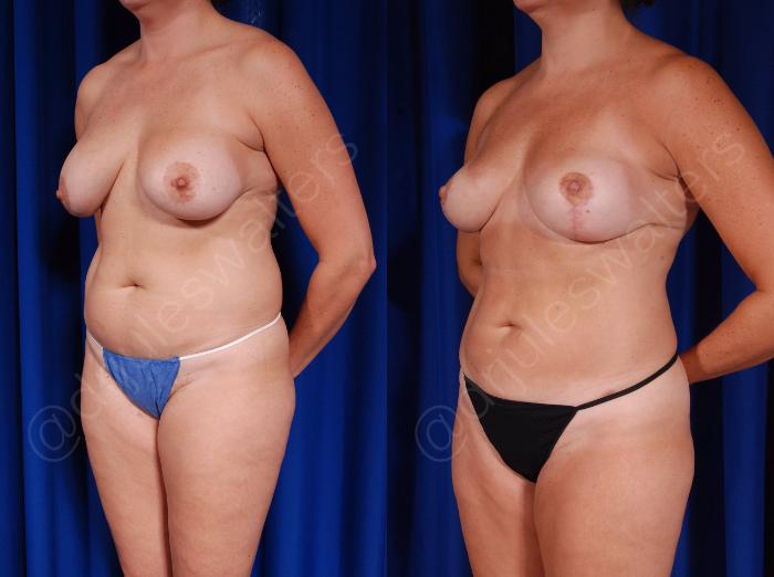 Before & After Breast Revision Case 127 View #4 View in Metairie and New Orleans, LA