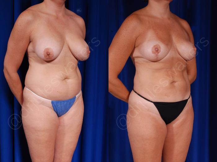 Before & After Breast Revision Case 127 View #5 View in Metairie and New Orleans, LA