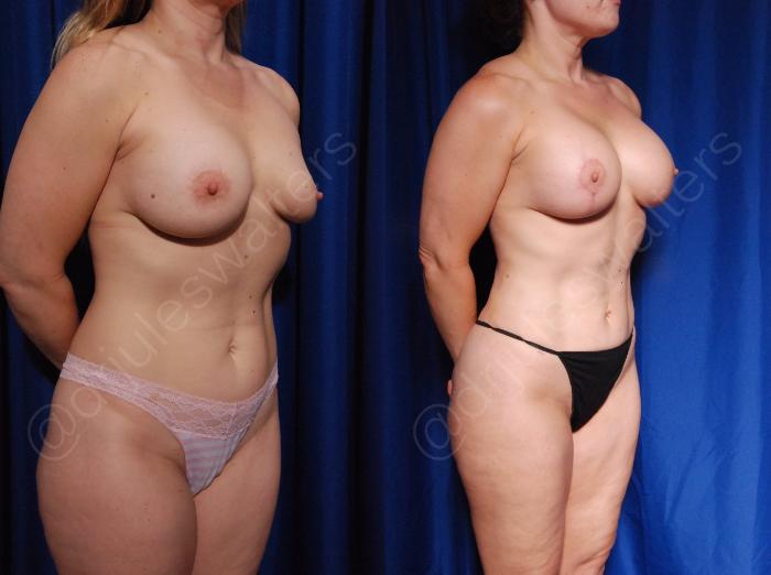 Before & After Breast Revision Case 128 View #4 View in Metairie and New Orleans, LA