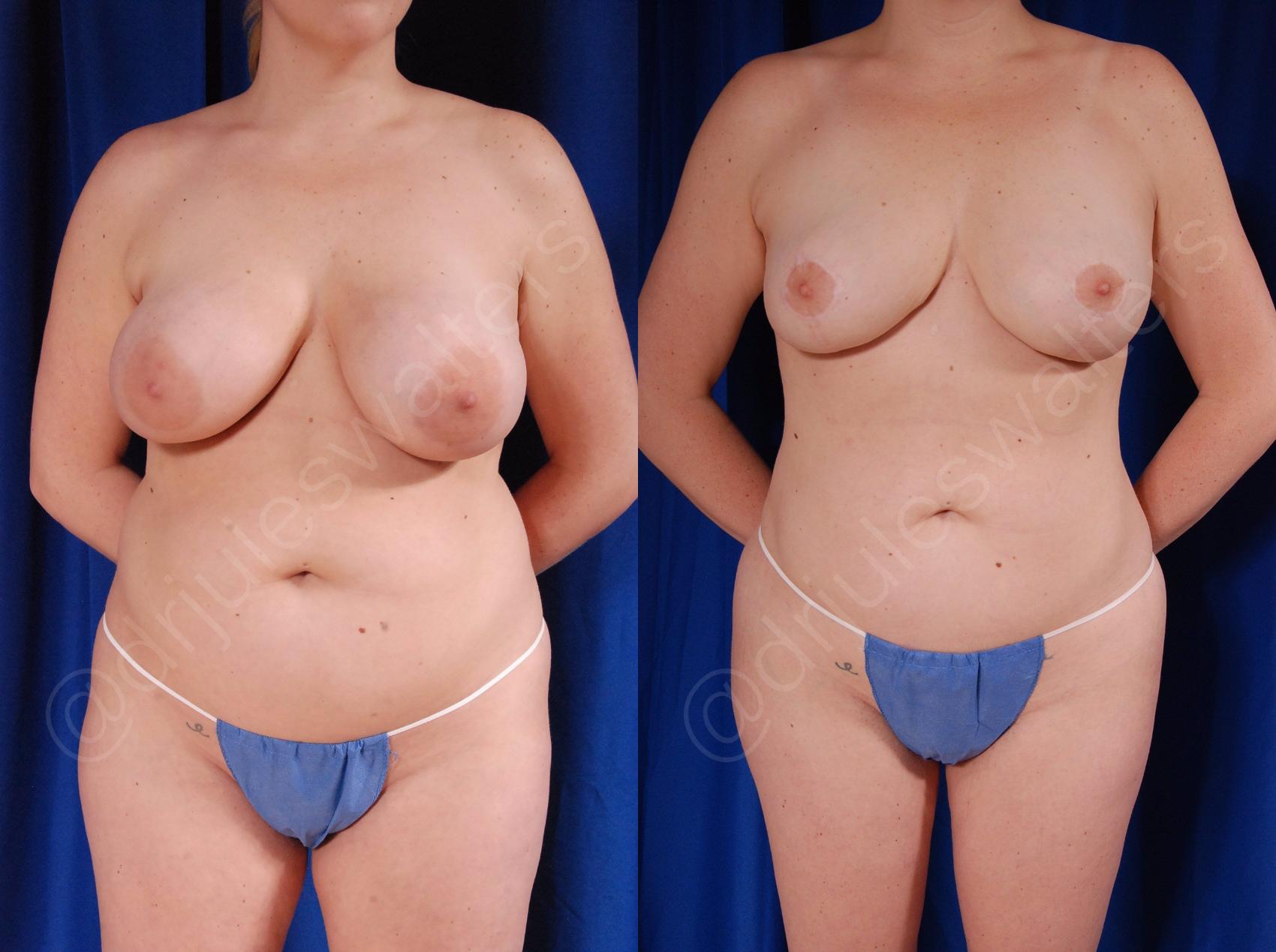 Before & After Breast Revision Case 129 View #1 View in Metairie and New Orleans, LA