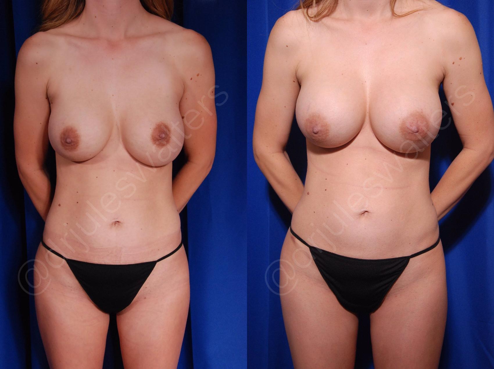 Before & After Breast Revision Case 130 View #1 View in Metairie, New Orleans, Covington, LA