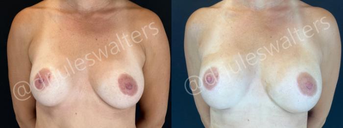 Before & After Breast Revision Case 189 Front View in Metairie and New Orleans, LA