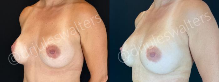 Before & After Breast Revision Case 189 Left Oblique View in Metairie and New Orleans, LA