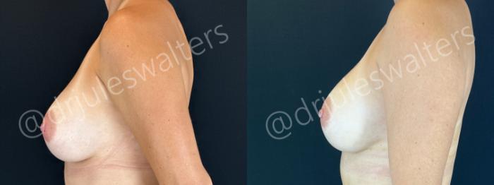 Before & After Breast Revision Case 189 Left Side View in Metairie and New Orleans, LA