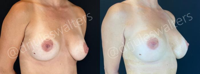 Before & After Breast Revision Case 189 Right Oblique View in Metairie and New Orleans, LA