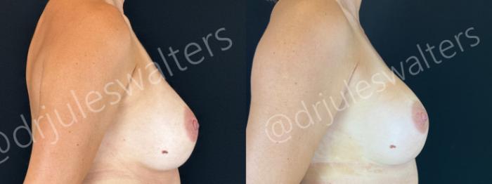 Before & After Breast Revision Case 189 Right Side View in Metairie and New Orleans, LA