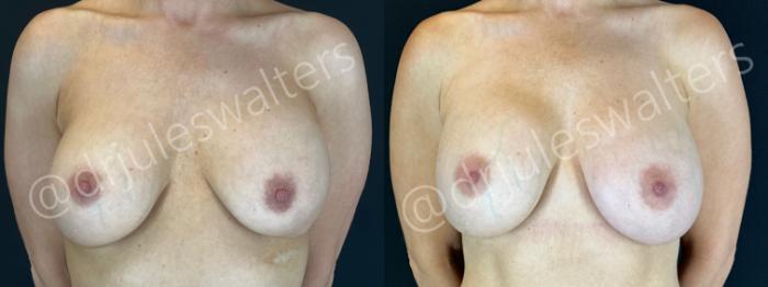 Before & After Breast Revision Case 194 Front View in Metairie and New Orleans, LA