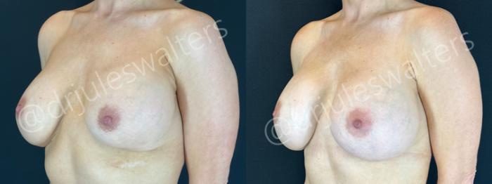 Before & After Breast Revision Case 194 Left Oblique View in Metairie and New Orleans, LA