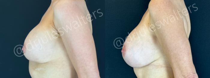 Before & After Breast Revision Case 194 Left Side View in Metairie and New Orleans, LA