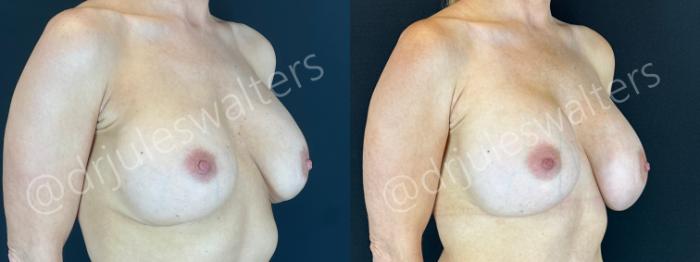 Before & After Breast Revision Case 194 Right Oblique View in Metairie and New Orleans, LA