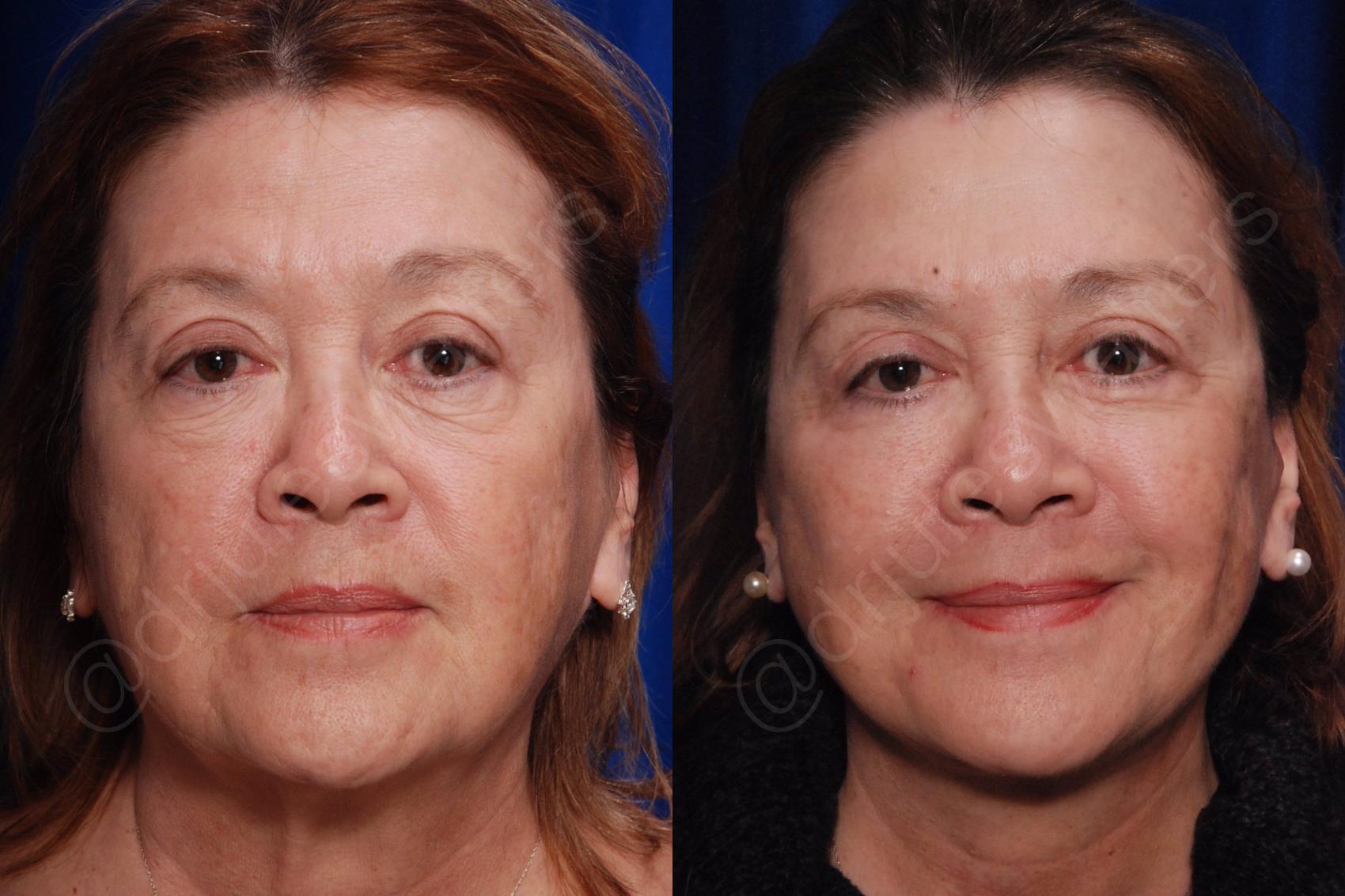 Before & After Facelift Case 135 View #1 View in Metairie, New Orleans, Covington, LA