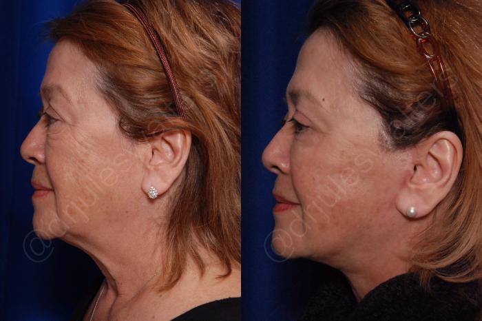 Before & After Blepharoplasty Case 135 View #2 View in Metairie and New Orleans, LA