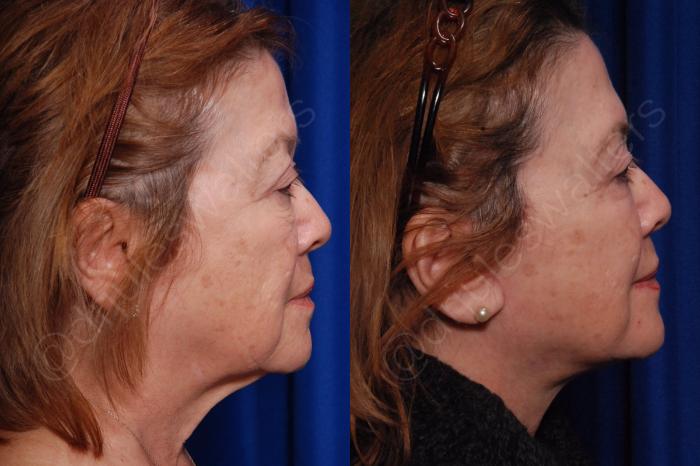 Before & After Facelift Case 135 View #3 View in Metairie and New Orleans, LA