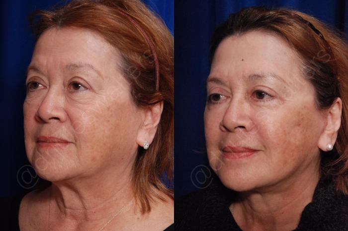 Before & After Blepharoplasty Case 135 View #4 View in Metairie and New Orleans, LA