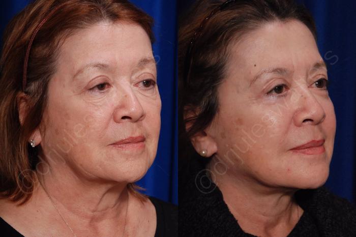 Before & After Facelift Case 135 View #5 View in Metairie and New Orleans, LA