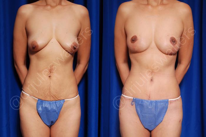 Before & After Breast Lift Case 20 View #1 View in Metairie and New Orleans, LA