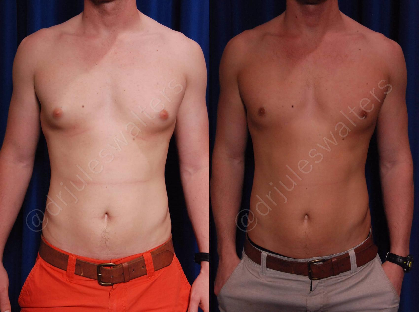 Before & After Gynecomastia Case 140 View #1 View in Metairie, New Orleans, Covington, LA