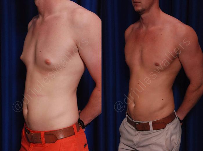 Before & After Gynecomastia Case 140 View #2 View in Metairie and New Orleans, LA