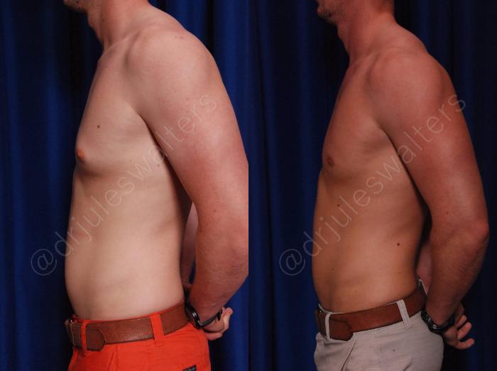 Before & After Gynecomastia Case 140 View #3 View in Metairie and New Orleans, LA