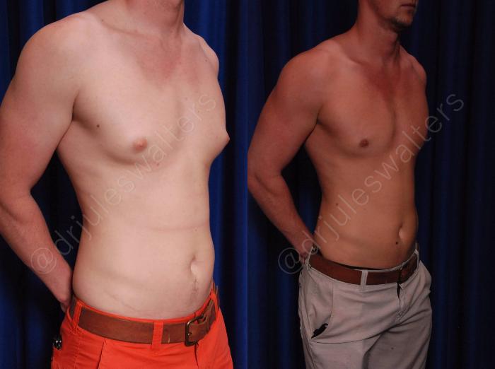 Before & After Gynecomastia Case 140 View #4 View in Metairie and New Orleans, LA