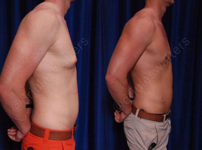 Before & After Gynecomastia Case 140 View #5 View in Metairie and New Orleans, LA