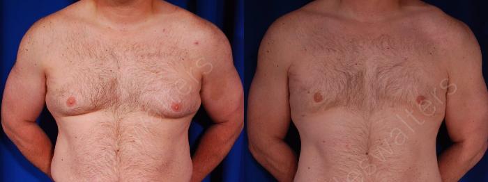 Before & After Gynecomastia Case 141 View #1 View in Metairie and New Orleans, LA