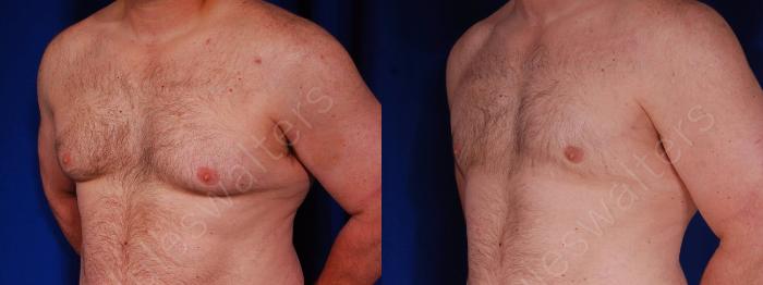 Before & After Gynecomastia Case 141 View #2 View in Metairie and New Orleans, LA