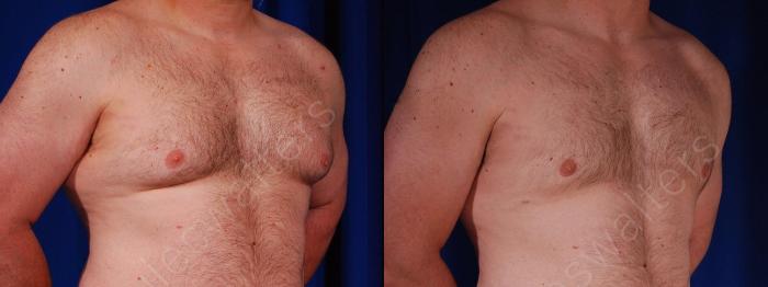 Before & After Gynecomastia Case 141 View #4 View in Metairie and New Orleans, LA