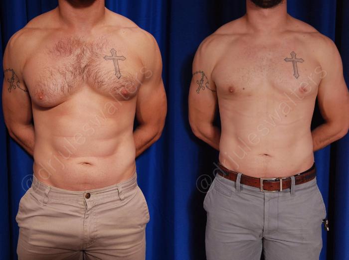 Before & After Gynecomastia Case 142 View #1 View in Metairie and New Orleans, LA