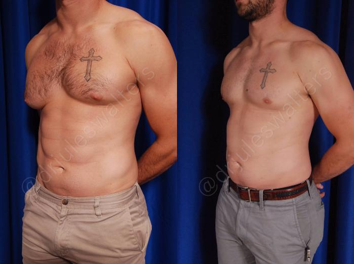 Before & After Gynecomastia Case 142 View #2 View in Metairie and New Orleans, LA