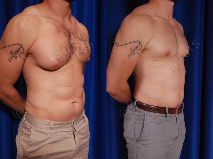 Before & After Gynecomastia Case 142 View #3 View in Metairie and New Orleans, LA