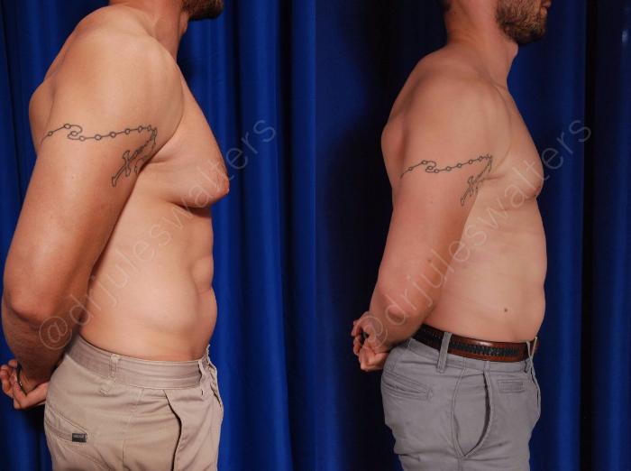 Before & After Gynecomastia Case 142 View #4 View in Metairie and New Orleans, LA
