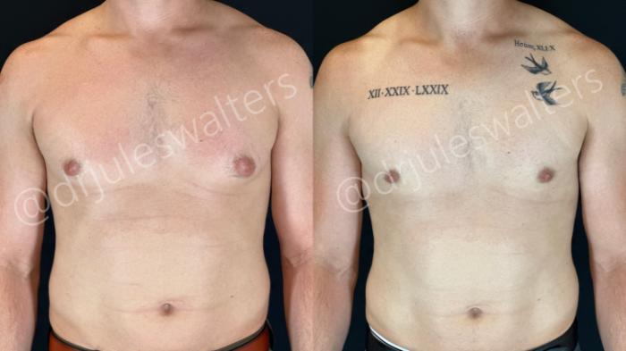 Before & After Gynecomastia Case 157 Front View in Metairie and New Orleans, LA