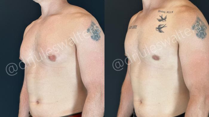 Before & After Gynecomastia Case 157 Left Oblique View in Metairie and New Orleans, LA