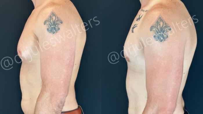 Before & After Gynecomastia Case 157 Left Side View in Metairie and New Orleans, LA