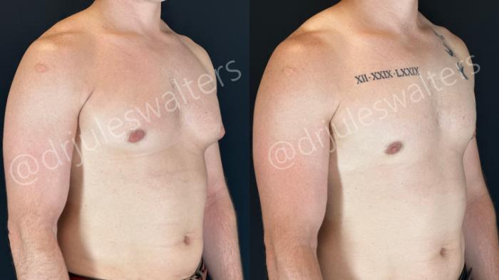 Before & After Gynecomastia Case 157 Right Oblique View in Metairie and New Orleans, LA