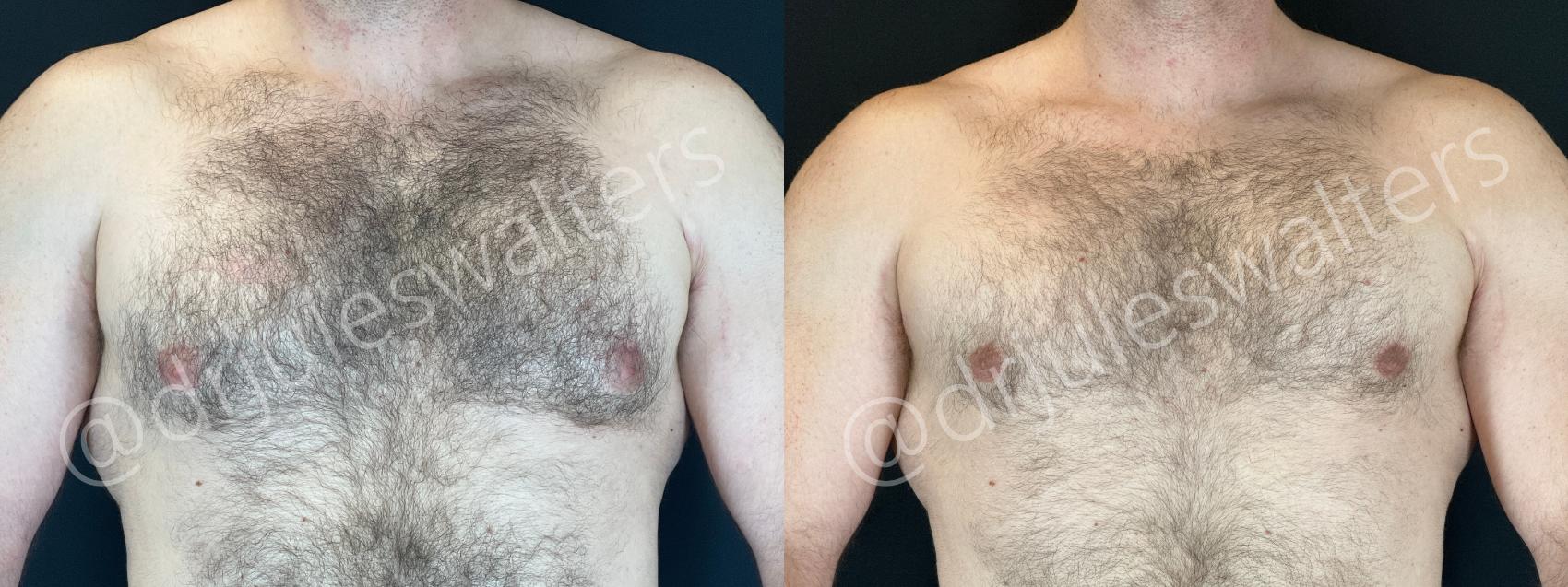 Before & After Gynecomastia Case 167 Front View in Metairie and New Orleans, LA