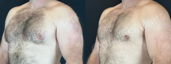 Before & After Gynecomastia Case 167 Left Oblique View in Metairie and New Orleans, LA