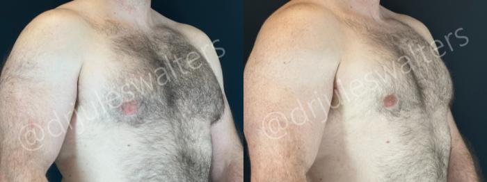 Before & After Gynecomastia Case 167 Right Oblique View in Metairie and New Orleans, LA