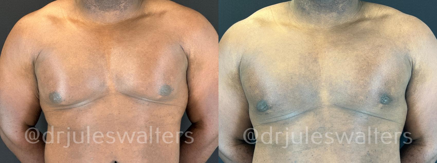 Before & After Gynecomastia Case 173 Front View in Metairie and New Orleans, LA
