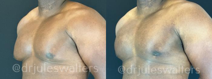 Before & After Gynecomastia Case 173 Left Oblique View in Metairie and New Orleans, LA