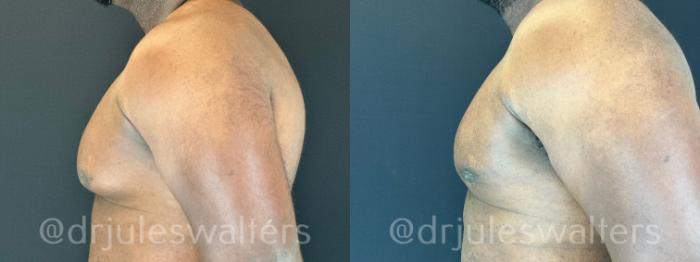Before & After Gynecomastia Case 173 Left Side View in Metairie and New Orleans, LA
