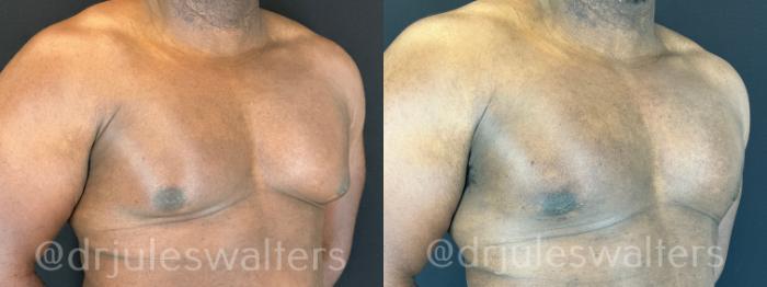 Before & After Gynecomastia Case 173 Right Oblique View in Metairie and New Orleans, LA