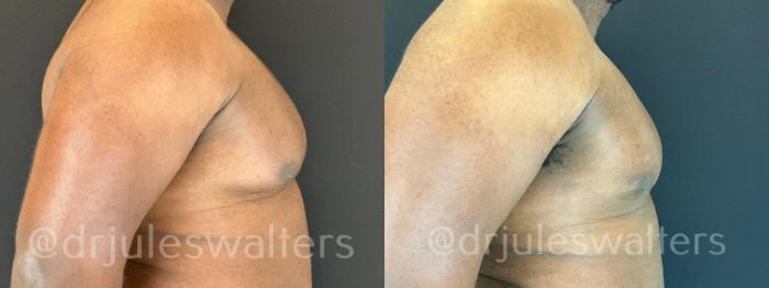 Before & After Gynecomastia Case 173 Right Side View in Metairie and New Orleans, LA